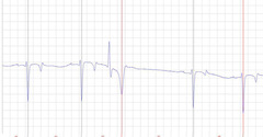 <p>What is happening in this ECG</p>