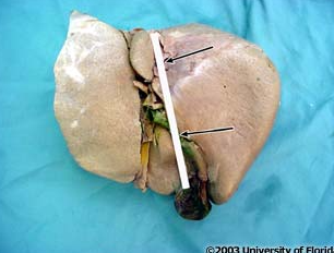 <p>what liver fissure on the VISCERAL surface of the liver is being highlighted?</p>