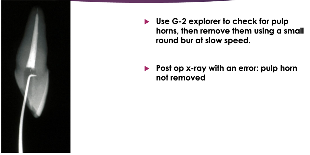 <p>use G2 explorer → if catching → use a small round bur at slow speed </p>