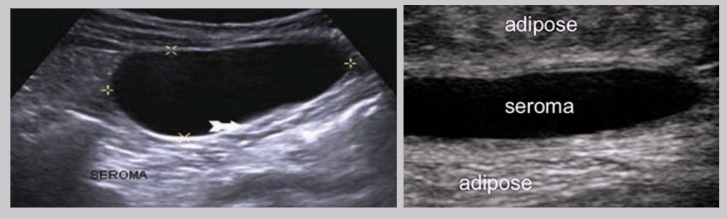 <ul><li><p><span style="background-color: transparent;">Collection of serum in the tissue&nbsp;</span></p></li><li><p><span style="background-color: transparent;">Results from a surgical incision or liquefaction of a hematoma&nbsp;</span></p></li><li><p><span style="background-color: transparent;">Distinct from hematomas because they contain no red blood cells&nbsp;</span></p></li><li><p><span style="background-color: transparent;">US Findings:&nbsp;</span></p><ul><li><p><span style="background-color: transparent;">Anechoic cystic structure</span></p></li><li><p><span style="background-color: transparent;">Well-circumscribed</span></p></li><li><p><span style="background-color: transparent;">Posterior enhancement</span></p></li></ul></li></ul><p></p>