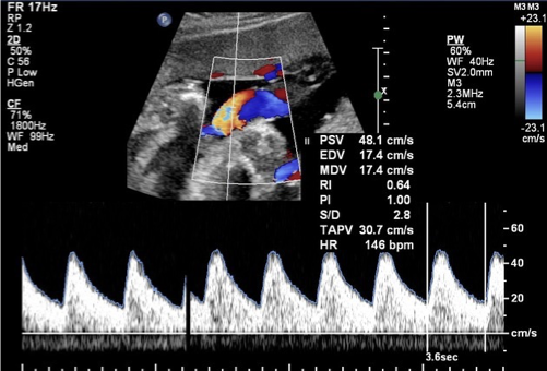 <p>umbilical artery (UA) doppler</p>