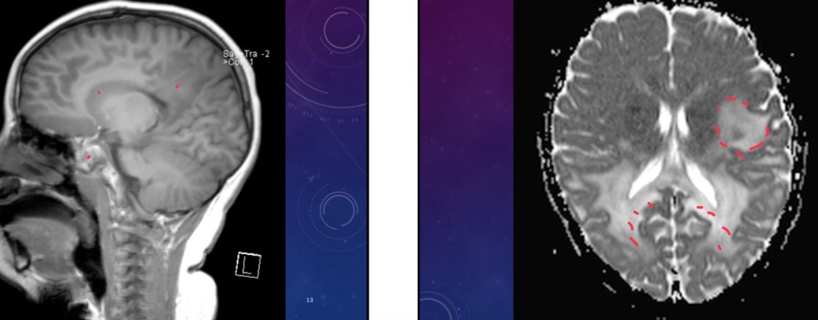 <p> 6 year-old male has progressive, bilateral visual impairment, and poor motor progression for his age</p>