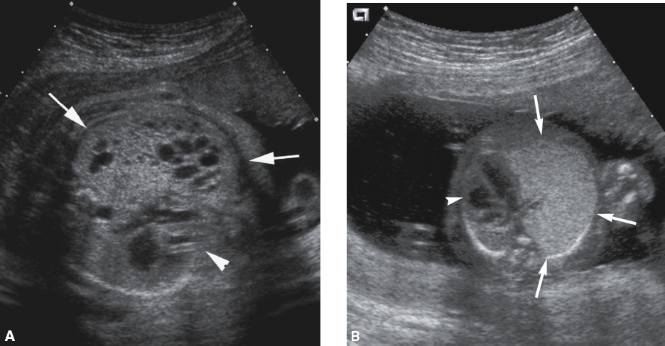 <p>Lung mass with varying degrees of cystic and solid components</p><p>Completely echogenic mass within the lungs</p><p>Pleural effusion may be present</p>