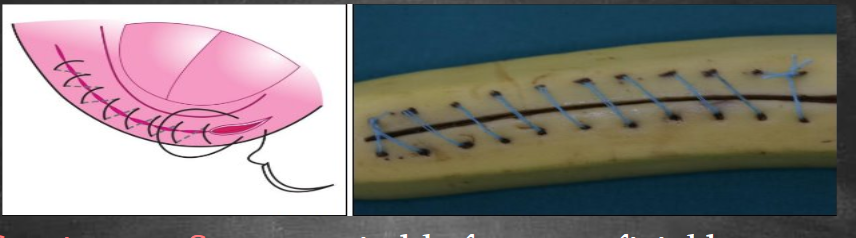 <ul><li><p>a single strand runs through the entire wound and is tied only at the ends</p></li><li><p>advantages = faster, distributes tension evenly</p></li><li><p>disadvantages= if one point fails, the whole line can loosen</p></li><li><p>simple continuous = basic running stitch</p></li><li><p>locking continuous (ford interlocking) = Each pass locks the stitch. bad tension distribution, often used in skin</p></li><li><p>subcuticular = placed in dermis only (not used in intraoral mucosa)</p></li></ul><p></p>