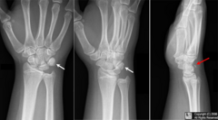<p>Need lateral view → Pisiform overlies Triquetrum on frontal view</p>