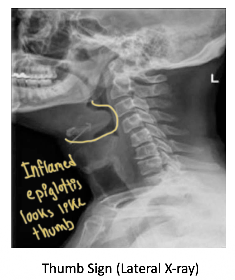 <p><span>"Inflammation of the epiglottis due to H influenze type b infection (now not as common due to Hb vaccine) </span><br><br><strong>Presentation:</strong><span> Child with high fever, drooling, dysphagia & in the tripod position (hands on knees and head titled) to get more air</span><br><span>"Hand on my knees, Hb, epligottis"" Think of Thot Sh** by Meg thee Stallion </span><br><br><strong>Tracheal deviation & percussion:</strong><span> None</span><br><br><strong>Lung sound:</strong><span> Respiratory stridor</span><br><br><strong>Imaging:</strong><span> ""Thumb sign"" on lateral neck X-ray</span></p><p></p>