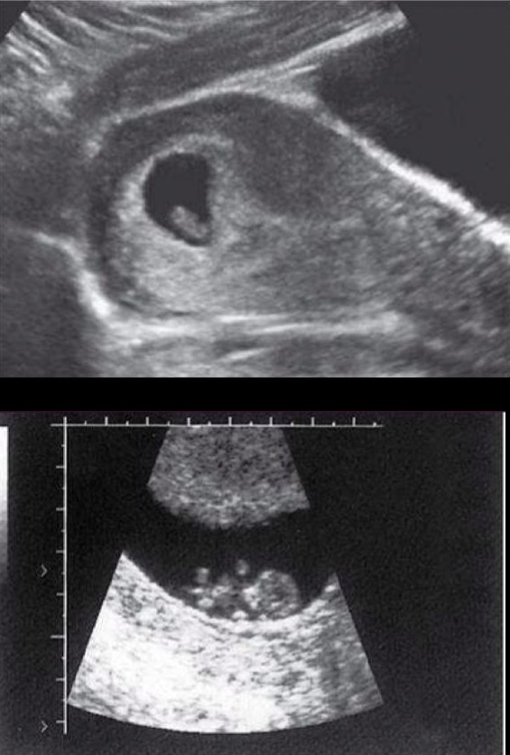 <p>Varies depending on age of embryo, with TV can see around 5.5 weeks; echogenic; cardiac activity by 6 weeks</p>