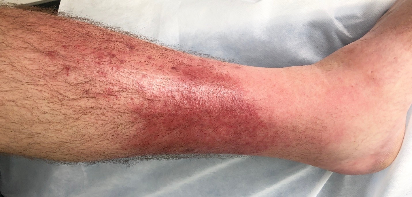 <p>Cellulitis</p>