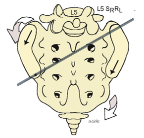 <ul><li><p>deep sulcus → L</p></li><li><p>seated flexion test → L</p></li><li><p>inferior/posterior ILA → R</p></li><li><p>sacrotuberous ligament taught → R</p></li><li><p>Spring test → neg</p></li></ul><p></p>