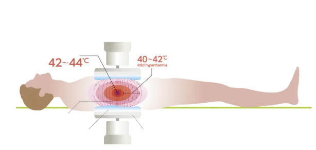 <ul><li><p>hyperthermia = increasing temp → 39-44C</p></li><li><p>increases tumour susceptibility → cooks the cell</p></li><li><p>more targeted chemotherapy → thermoresponsive liposomes</p></li><li><p>specificity can be improved</p></li></ul><p></p>