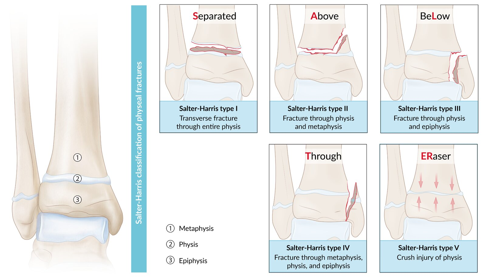 <p>Salter-harris fractures: SALTER</p><p>Type 1: Straight across joint</p><ul><li><p>Transverse fracture through physis</p></li><li><p>Separate epiphysis from metaphysis</p></li></ul><p>Type 2: Above joint</p><ul><li><p>Transverse fracture through physis + metaphysis</p></li><li><p>Most common</p></li></ul><p>Type 3: Lower</p><ul><li><p>Transverse fracture through physis + epiphysis</p></li></ul><p>Type 4: Through everything</p><ul><li><p>Fracture through physis + epiphysis + metaphysis</p></li><li><p>Intraarticular fracture</p></li></ul><p>Type 5: Ruined/rammed</p><ul><li><p>Crush injury from compression</p></li></ul><p></p>
