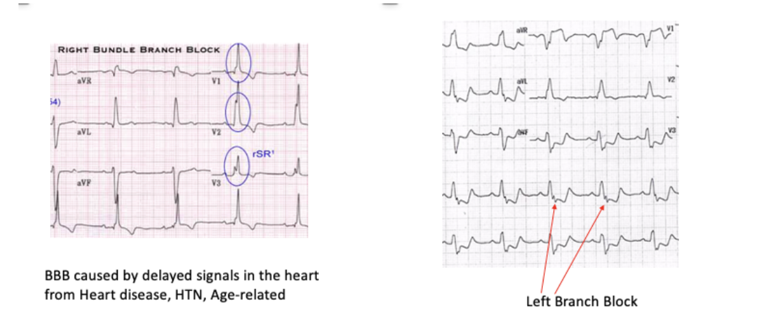 <ul><li><p><span style="background-color: transparent; font-family: "Times New Roman", serif;"><em>Right Bundle Branch Block→ the right ventricle effected </em></span></p></li><li><p><span style="background-color: transparent; font-family: "Times New Roman", serif;"><em>Left Bundle Branch Block→ the ventricle is effected </em></span></p></li></ul><p></p>