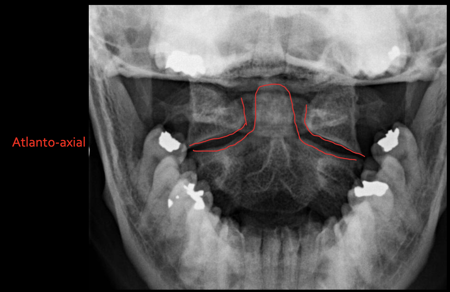 <p><strong>Atlanto-axial</strong></p>