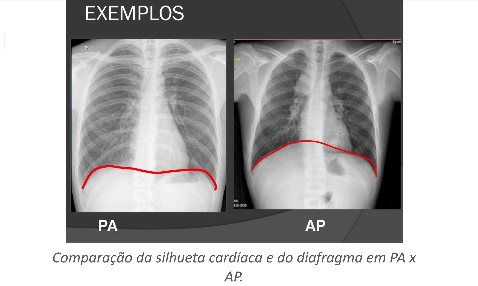 <p>Quando o índice cardiotorácico deve, idealmente, ser avaliado?</p>