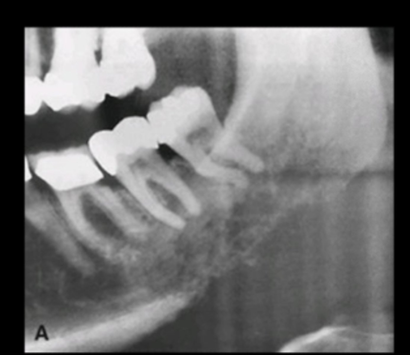 <p>More likely in the body of the mandible (bc largest vascular supply here)</p>