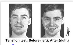 <p>Used to diagnose MG --> injection of tensilon --> inhibits acetylcholinesterase --> more acetylcholine in NMJ --> improves muscle strength in MG patients</p>