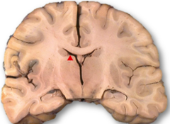 <p>What are gross features of generalized cerebral edema?</p>