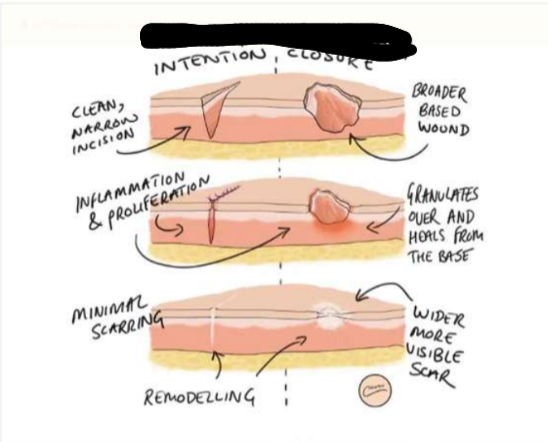 <p>which side is primary healing and which is secondary</p>