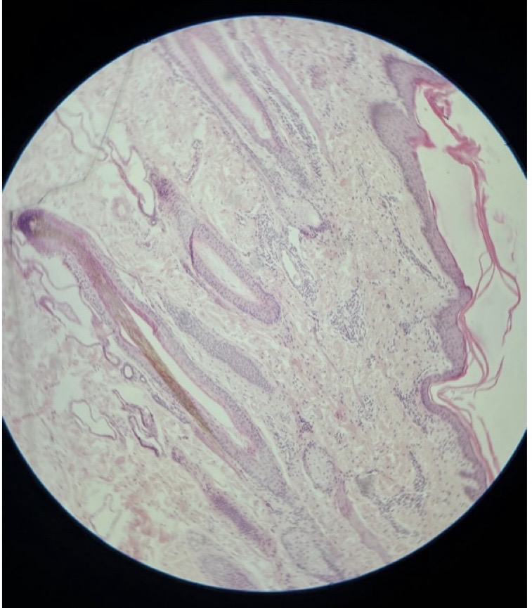 <p>A histological slide containing sweat glands, hair folides, and sebaceous glands.</p>