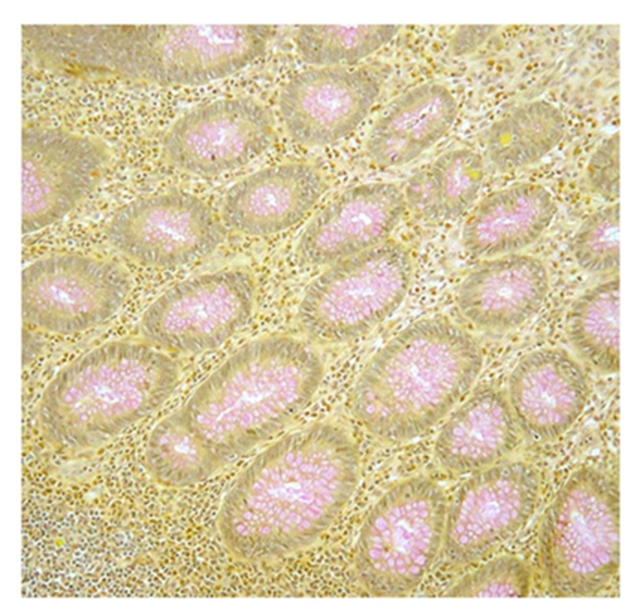 <p>preparing new stock solution</p><p>Feedback:</p><p>The mucicarmine stock solution has either been improperly prepared or has deteriorated. A new solution should be prepared or obtai thicker sections would not help the weak mucicarmine staining; and if the stock and working solutions are properly prepared, no pH adjustment is necessary.</p>