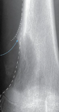 <p>a triangular elevation of periosteum in osteosarcoma </p>