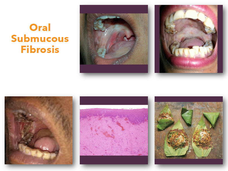 <p>oral submucous fibrosis overview </p>