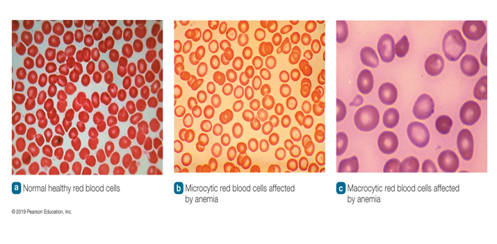 <p>Macrocytic Anemia</p>