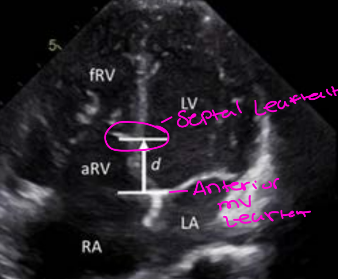 <p>It measures the displacement between:</p><ul><li><p>Measuring the distance between the hinge point of the anterior mitral valve leaflet</p></li><li><p>^ & The displaced hinge point of the septal tricuspid valve leaflet</p></li></ul><p>The distance is then divided by the patient’s body surface area.</p>