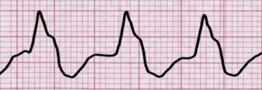 <p>non-pulsatile ventricular tachycardia treatment</p>