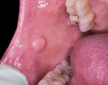 <p>abnormal tissue growth, can be benign or precancerous</p>