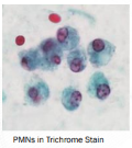 <ul><li><p>May be confused with <strong>PMNs during microscopic examination</strong></p></li><li><p>Size averages 20 μm (smaller on permanent stained smears)</p></li><li><p>Displays a <strong>nuclear-to-cytoplasmic ratio of 1:2 to 1:3 for cysts (1:10 to 1:12 for trophozoites)</strong></p></li><li><p>Characterized by a r<strong>ound nucleus with a central karyosome and peripheral chromatin</strong></p></li><li><p>Contains uniform, agranular cytoplasm (may contain ingested RBCs)</p></li><li><p>Stains with green cytoplasm and dark red nuclear material on Trichrome stain</p></li></ul><p></p>
