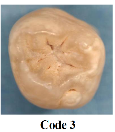 <p>Localized enamel breakdown and widening of fissures without visual signs of dentin or shadowing</p>