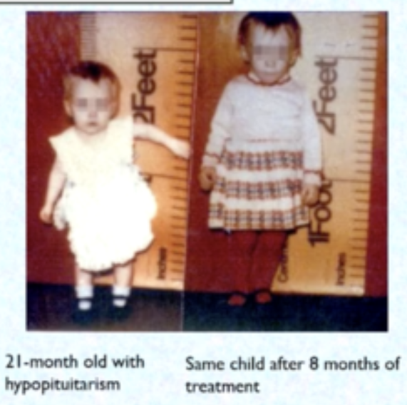 <ol><li><p><span style="color: rgb(242, 83, 83);"><strong>short stature</strong> but proportional</span></p></li></ol><ul><li><p><span style="color: rgb(14, 9, 9);">child is</span><span style="color: rgb(242, 83, 83);"> shorter than expected for their age, </span><span style="color: rgb(8, 5, 5);">but their body</span><span style="color: rgb(242, 83, 83);"> proportions are normal</span></p></li></ul><ol start="2"><li><p><span style="color: rgb(113, 159, 22);"><strong>delayed epiphyseal closure</strong></span></p></li></ol><ul><li><p><span style="color: rgb(113, 159, 22);">growth plates </span><span style="color: rgb(16, 13, 13);">at the ends of long bones sta</span><span style="color: rgb(113, 159, 22);">y “<strong>open</strong>” longer </span><span style="color: rgb(35, 27, 27);">than usual</span></p></li></ul><ol start="3"><li><p><strong><span data-name="arrow_up" data-type="emoji">⬆</span></strong><span style="color: rgb(26, 174, 156);"><strong>insulin sensitivity</strong></span></p></li></ol><ul><li><p><span style="color: rgb(10, 5, 5);">body responds</span><span style="color: rgb(26, 174, 156);"> <strong>more strongly to insulin</strong>, meaning blood sugar is <strong>used efficiently</strong></span></p></li></ul><ol start="4"><li><p><span style="color: rgb(172, 59, 222);"><strong>delayed dentition</strong>, <strong>jaw, sexual development</strong></span></p></li></ol><ul><li><p><span style="color: rgb(172, 59, 222);">Teeth come in <strong>later</strong> than normal</span></p></li><li><p><span style="color: rgb(172, 59, 222);">Jaw </span><span style="color: rgb(2, 1, 1);">growth may be</span><span style="color: rgb(172, 59, 222);"> slower</span></p></li></ul><p></p>