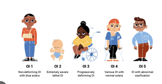 <p>Diagnose kan niet altijd met zekerheid worden gesteld op basis van alleen de symptomen. RX, MR, CT, botmetingen, DNA-onderzoeken en onderzoek van het collageen in de huid kan de diagnose ondersteunen. Er zijn verschillende types verdeeld op basis van kenmerken:</p><p>-OI type 1 → het minst ernstige type. Blauwe sclera, geen botbreuken bij de geboorte en geen botmisvorming na botbreuken.</p><p>-OI type 2 → botbreuken voor de 20ste zwangerschapsweek met ernstige misvorming van de botten, niet met leven verenigbaar.</p><p>-OI type 3 → vele botbreuken, voor het eerst waargenomen rond de 20ste zwangerschapsweek met ernstige misvorming van de botten. Men heeft een kleine lengte, de sclera is vaak grijswit en deze personen zijn meestal rolstoelafhankelijk. Het meest ernstige type dat met leven verenigbaar is.</p><p>-OI type 4 → botbreuken kunnen optreden aan het einde van de zwangerschap, er kan botmisvorming zijn na botbreuken. Er is geen blauwe sclera maar wel vaak een kleine lengte. De ernst varieert maar is nooit zo ernstig als type 3.</p><p>-OI type 5 → botbreuken kunnen optreden aan het einde van de zwangerschap, er is botvorming in het weefsel tussen het spaakbeen en de ellepijp waardoor de handpalmen niet naar boven en beneden kunnen draaien. Na botbreuken kan overmatige nieuwe botvorming ontstaan. Ernst is vergelijkbaar met type 4.</p>