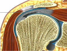 <p>Partial</p><p>Articular-sided</p><p>Supraspinatus</p><p>Tendon</p><p>Avulsion</p>