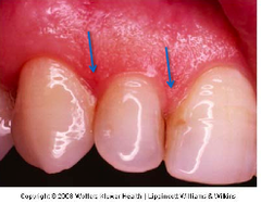 <p>gingival tissue between adjacent teeth adjoining attached gingiva</p>