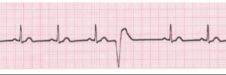 <p>What does this EKG show? </p>