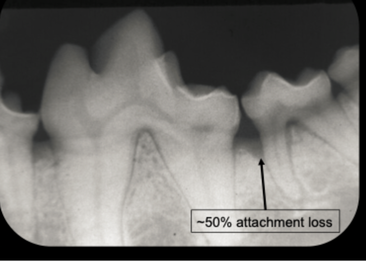 <p>What is the stage of periodontal disease shown in this image?</p>