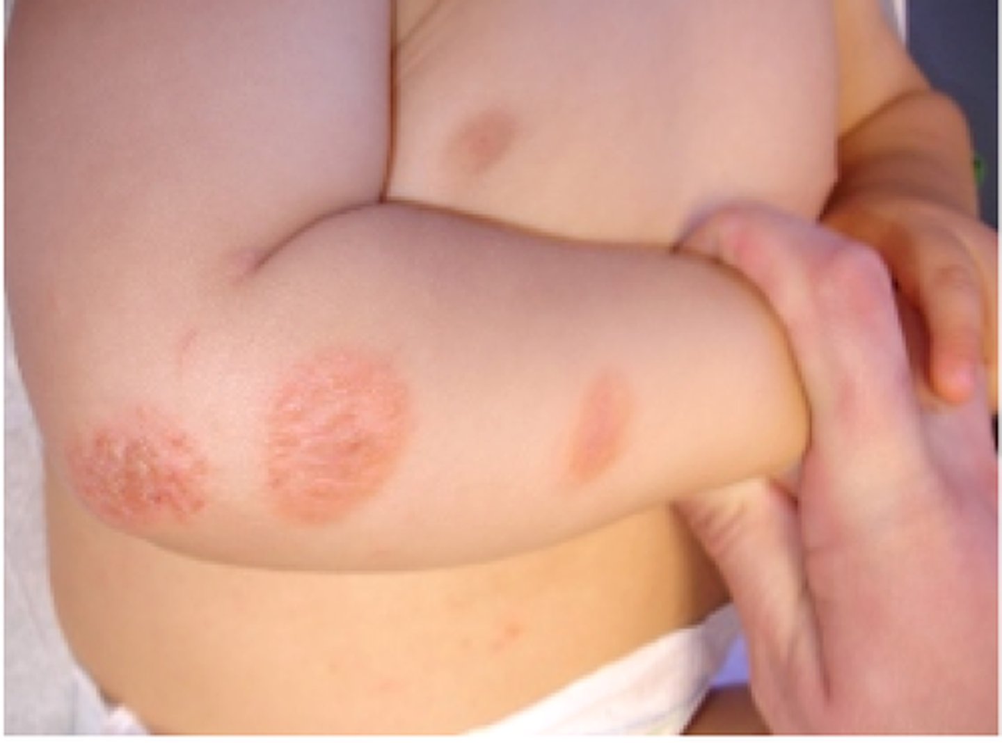 <p>Chronic dermatitis in which there are inflamed, coin-shaped, crusted and scaling pruritic lesions.</p>