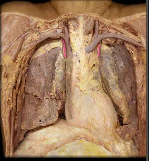 <p>passes down the anterior thorax lateral to the sternum</p>