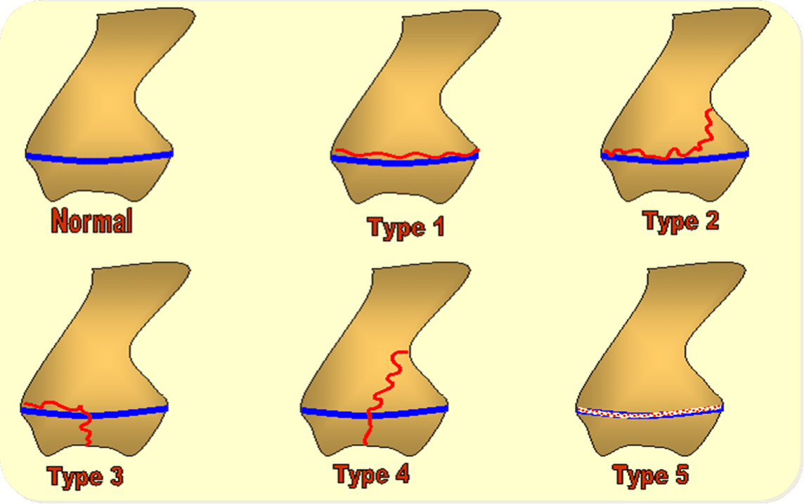 <p>Fracture grades </p>
