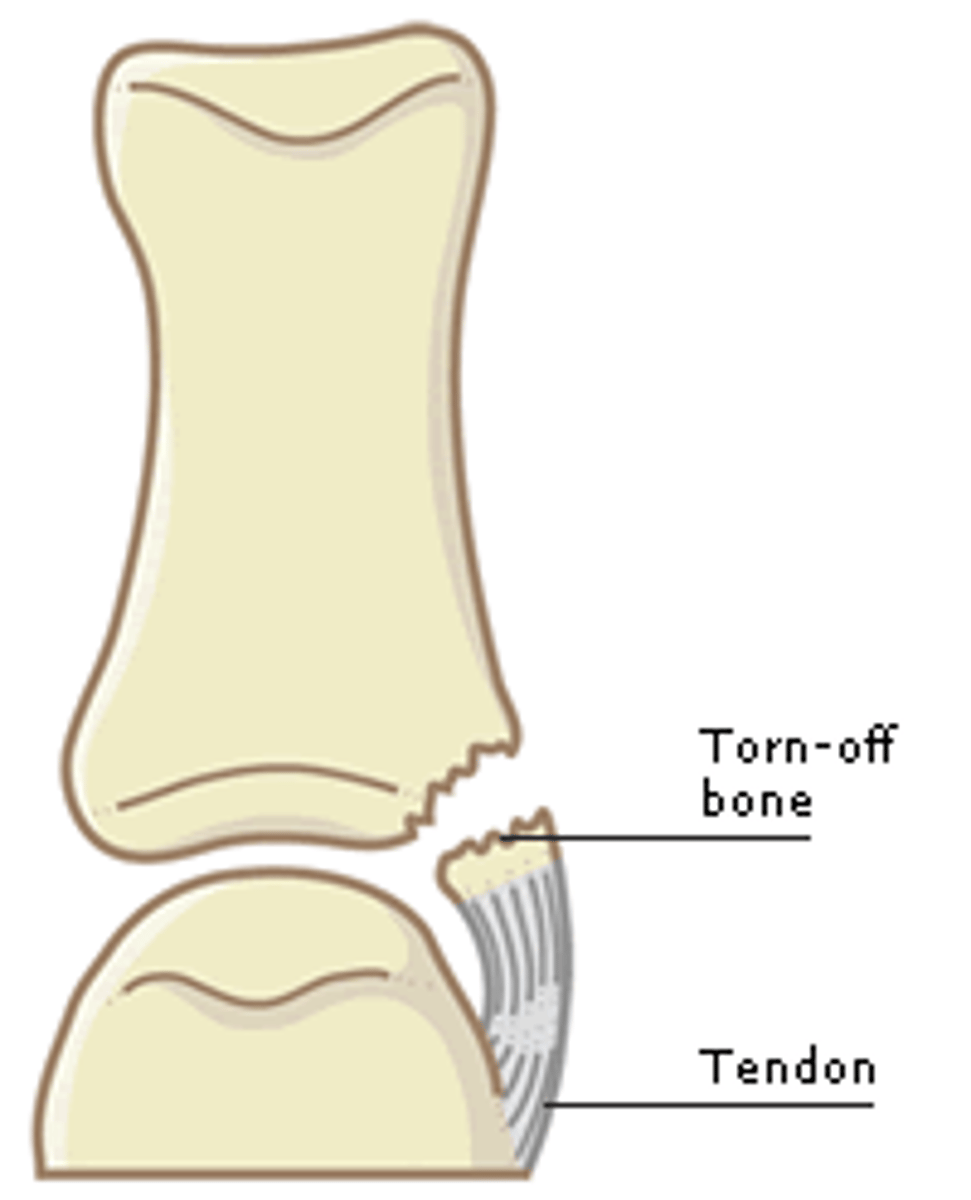 <p>knobby part of bone breaks off (wrists, ankles)</p>