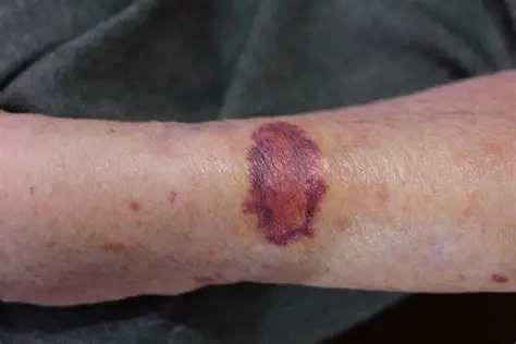 <p><span style="line-height: 107%;">a purplish patch resulting from extravasation of blood into the skin, more than. 3mm in diameter</span></p>