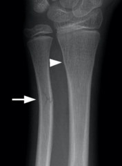 <p>incomplete fracture; bone bent</p>