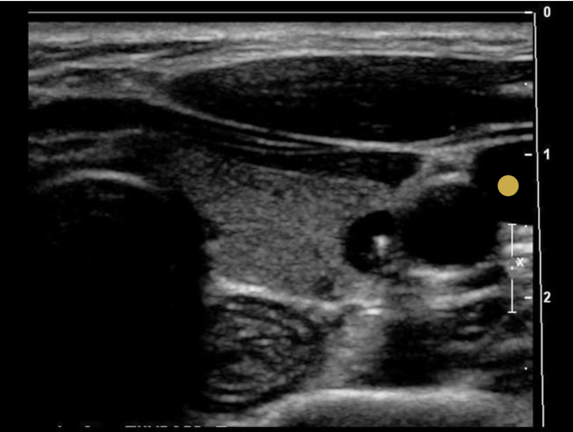 <p>The common carotid artery is lateral to the thyroid gland. The internal jugular vein is slightly anterior and lateral to the common carotid artery.</p>
