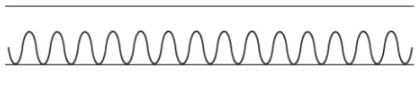 <p>Tachypnea </p>