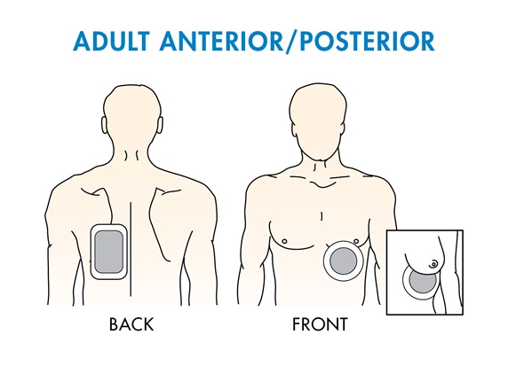 <ul><li><p>lateral pad (usually has a <span data-name="heart" data-type="emoji">❤</span>︎ on it) placed anterior → centered over apex area</p></li><li><p>posterior placed same horizontal level between spine + shoulder blade</p></li></ul><p></p>