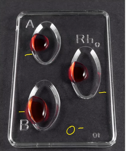 <p>O-NEG</p>