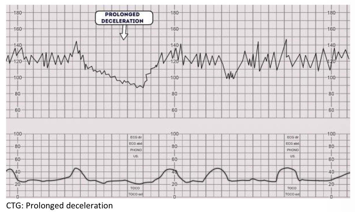 <p>Deceleration that lasts more than 2 minutes </p><p>Between 2-3 mins is non-reassuring </p><p>Longer than 3 minutes is abnormal </p>