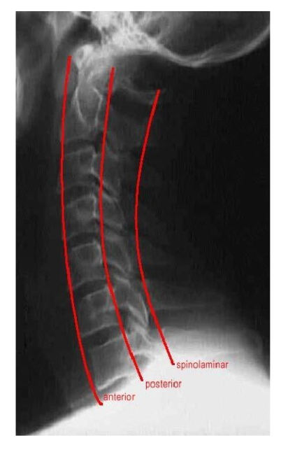 <p>smooth lines, bodies in register, spinous processes in register </p><p>in register- they are properly aligned without any deviation</p>
